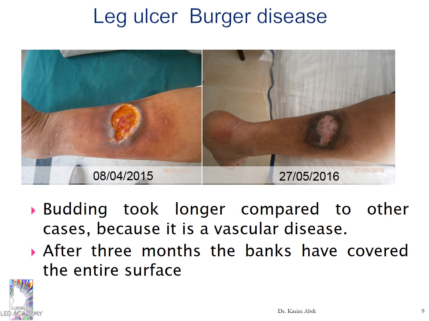 Diabetic foot and leg ulcers LED PRP -  Thérapie en PBM sur les pieds diabétiques - Dr ABDI Karim