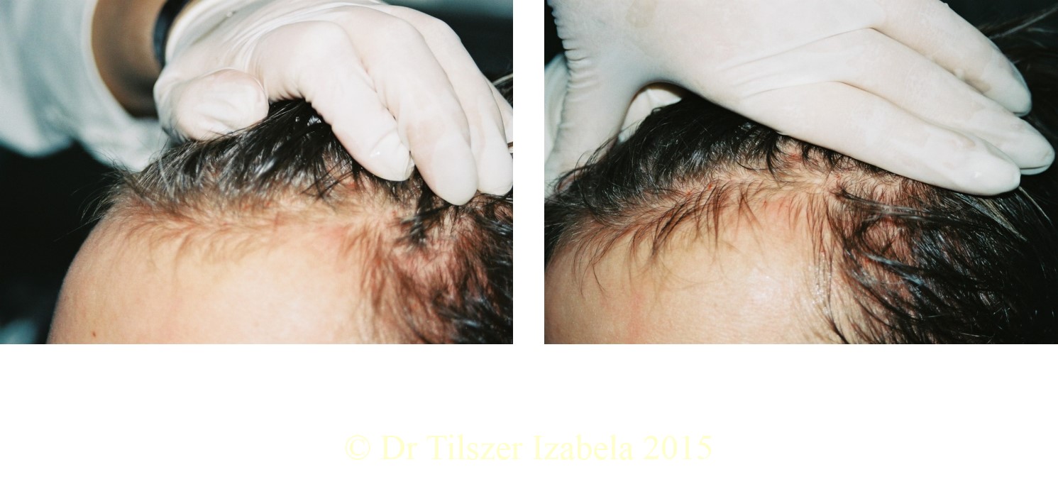Stress Mésothérapie, PBM, et chute de cheveux:  Barcelona part 3: Dr  Isabela TILSZER (Varsovie)